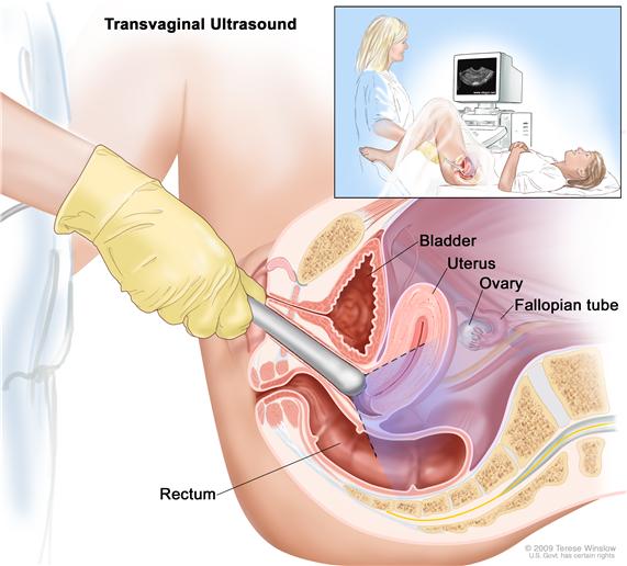 Trans vaginal Ultrasound