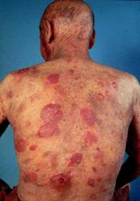 Mycosis Fungoides