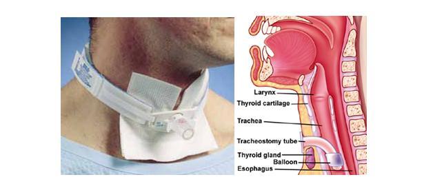 Tracheostomy Tubes