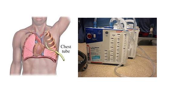 Chest Tubes