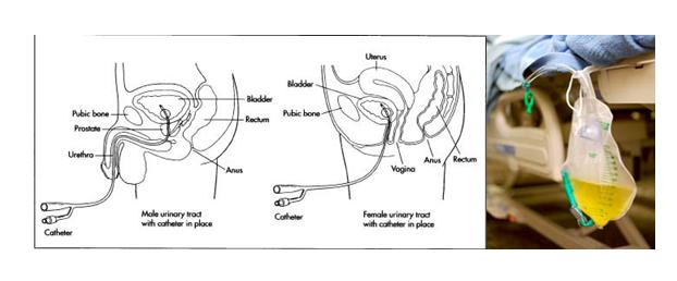 Urinary Catheters